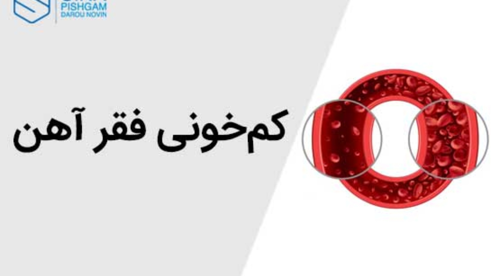 کم‌خونی فقر آهن